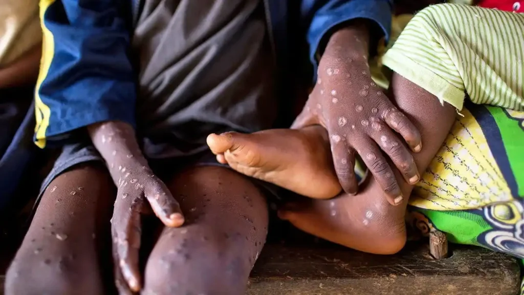 WHO Warns of Potential Surge in Clade 1 Mpox Cases Across Europe